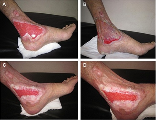 Figure 4 Healing of two leg ulcers after amniotic membrane application.