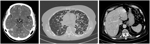Figure 1. (Left to right) axial computed tomography imaging demonstrating miliary metastases in the brain, lung and liver from non-small cell lung cancer.