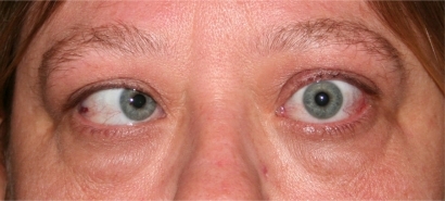 Figure 3 Esotropia strabismus is a common manifestation of medial rectus enlargement in thyroid eye disease.