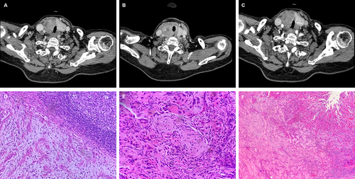 Figure 1 Representative pathological images of a case of ATC. (A) CT scan of the involvement of the trachea by ATC. (B) Intratumoral calcification and the involvement of the trachea by ATC. (C) CT scan of lymph node metastases in the carotid sheath. (D) Pathological image of cervical lymph node metastases (magnification=200×). (E) Pathological image of perineural invasion by ATC (magnification=400×). (F) Pathological image of skeletal muscle invasion by ATC (magnification=100×).