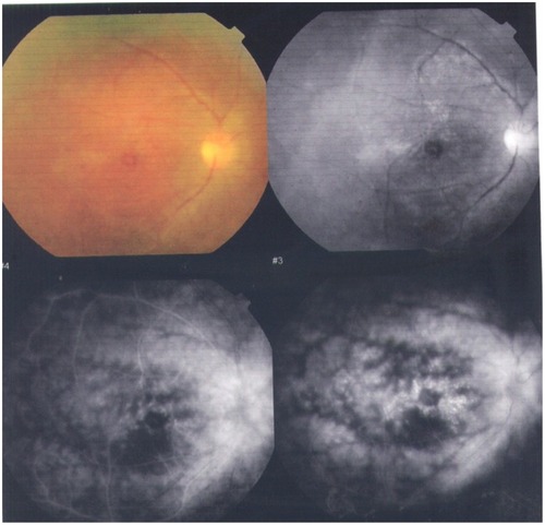 Figure 3 The only case with cystoid macular in the study.