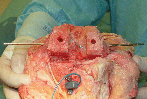 Figure 1. Anatomical specimen demonstrating pins placed medial and lateral in the transepicondylar axis, with a midline pin approximating the “femoral center” landmark which is referenced for the Medtronic StealthStation Treon system. Note the position of the intramedullary rod placement and that all bone cuts, including the femoral notch cut, are not interfered with by this pin placement.