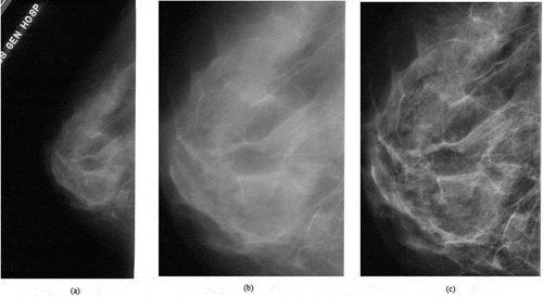 Figure 2. (a) The original mammogram image, (b) cropped image and (c) image filtered with CLAHE.