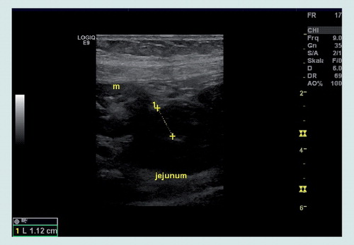 Figure 2. Jejunal hematoma with jejunal wall thickening on ultrasound scan.