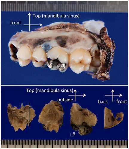 Figure 3. (a) Macroscopic photo of the lateral view of the surgically resected specimen. A blackish-brownish bulging mass measuring 10 × 9 cm in the left upper gingiva (5th–6th), associated with blackish-brownish spotty pigmentations at the lateral side (4th–7th) are observed. (b) Sectioned view of the same specimen. The blackish-brownish color tumor located around the fifth tooth. The thickness of the tumor was determined to be less than 1 cm.