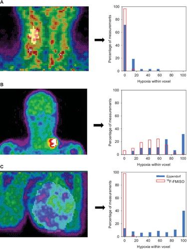Figure 2. Three examples of 18F-FMISO tumor imaging and the corresponding virtual voxel histograms. A: Patient number 1 with concordance between Eppendorf pO2 measurements and 18F-FMISO PET (both showing little/no hypoxia). B: Patient number 12 likewise with concordance between Eppendorf pO2 measurements and 18F-FMISO PET (both showing hypoxia). C: Patient number 15 with lack of con cordance between Eppendorf pO2 measurements (showing high degree of hypoxia) and 18F-FMISO PET (showing very little hypoxia).