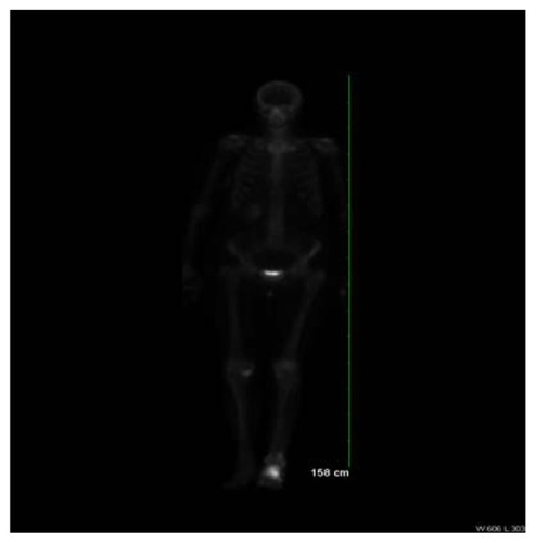 Figure 4 Technetium-99m MDP whole body bone scan displaying intense increased radioactive uptake in the left calcaneus with mild increased radioactive uptake in the proximal and distal left fibula with some extension into the shaft.