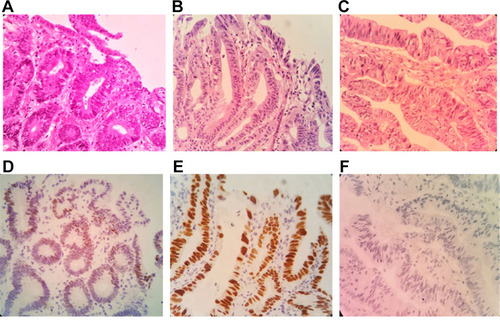 Figure 2 Immunohistochemical observation of the expression of mutant p53 protein in different cell atypical adenocarcinomas (400×). (A) Low-grade atypical adenocarcinoma (HE). (B) High-grade atypical adenocarcinoma (HE). (C) High-grade atypical adenocarcinoma (HE). (D) The low expression of mutant p53 protein in low-grade atypical adenocarcinoma. (E) The high expression of mutant p53 protein in high-grade atypical adenocarcinoma. (F) No expression of mutant p53 protein in high-grade atypical adenocarcinoma.