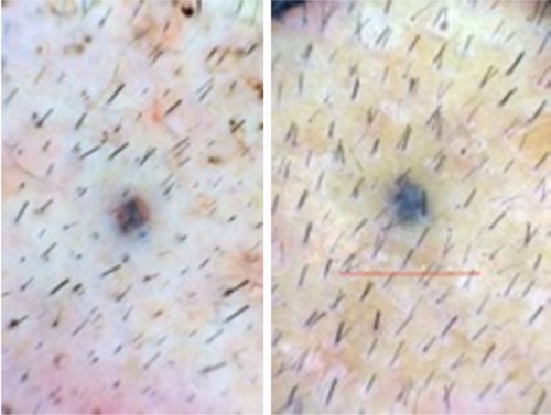 Figure 13 Baseline (left) versus 24-week (right) macrophotograph of fat + stromal vascular fraction-treated vertex of the patient in Table 8.