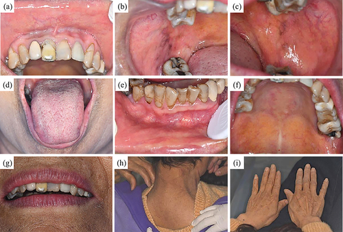 Figure 4 The lesions of the oral mucosa (a): labial mucosa; (b and c): buccal mucosa; (d): tongue; (e): gingiva; and (f): hard palate and skin (g): skin around the mouth; (h): posterior neck; (i): back of the hand were healed with pigmentation, with no recurrence over a period of three years.