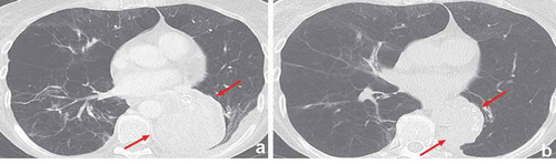 Figure 9. This patient was successfully treated with endobronchial valves in the left lower lobe. Two years later the patient presented with a postobstruction pneumonia. (a): The CT-scan showed an increased volume of the atelectasis of the left lower lobe. (b): After treatment with antibiotics and removal of two of the valves, there was clinical improvement and partial resolution of the consolidation. Due to the important initial clinical benefit of the valve treatment, this patient was treated by VATS lobectomy after full recovery of the pneumonia, rather than removal of the valves and experienced persistent clinical benefit