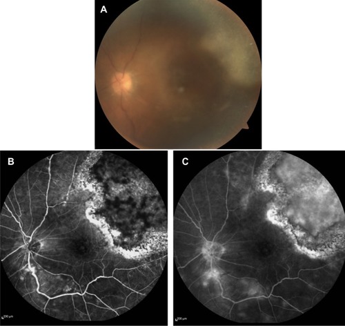 Figure 2 Fundus photograph and fluorescein angiography at 3 months after surgery.