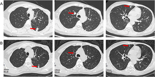 Figure 2 Chest and abdominal enhanced computed tomography(CT) scans show lung metastases before and after anlotinib and T-DXd therapy. (A) lung metastases before anlotinib and T-DXd therapy; (B) partial response in lung metastases after anlotinib and T-DXd treatment.