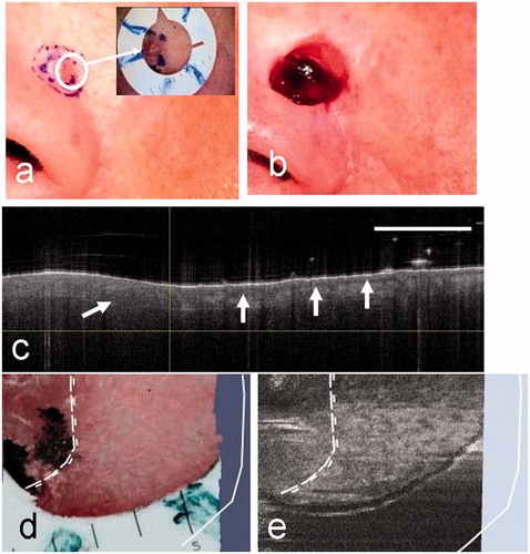 Figure 6. Clinical images of a micronodular BCC from patient 4 before surgery (a) and after surgery showing the MMS defect (b). In this case, the surgeon has marked two borders (a): the clinical border and the normal 2-mm margin around this representing the first MMS stage. The dermoscopy image (inset) shows the fiducial marker in a selected position on a segment of the pre-surgical margin. (c) The OCT image showing normal skin to the right of the clinical border (vertical line) with the DEJ (arrowed). To the left of the clinical border, within the lesion, a single ovoid BCC cell nest may be visible. The clinical and OCT borders are coincident in this case. (d) An enlargement of the dermoscopy image showing the position of the clinical and coincident OCT borders (dotted lines) and the surgical defect (solid white line). (e) The corresponding en face OCT view with the same superimposed borders.