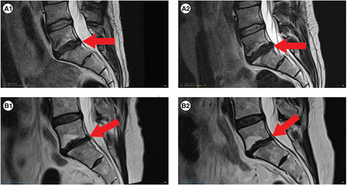 Figure 8. MRI images showing two participants at (i) baseline and (ii) 12 months post procedure.(A1 & 2) Represents participant 04 from Table 5 and shows no changes from baseline to follow-up. (A1) Participant 04, baseline. (A2) Participant 04, 12 months. (B1 & 2) Represents participant 07 from Table 5 and shows no changes in disc height, no progression of Modic 2 endplate changes and a reduction in disc protrusion size. (B1) Participant 05, baseline. (B2) Participant 05, 12 months.
