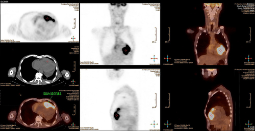 Figure 3 PET scan image of the heart on August 14, 2020, revealing increased FDG uptakes in the right submandibular and mediastinal lymph nodes, bilateral lungs, heart, and pericardium which impress metastases.