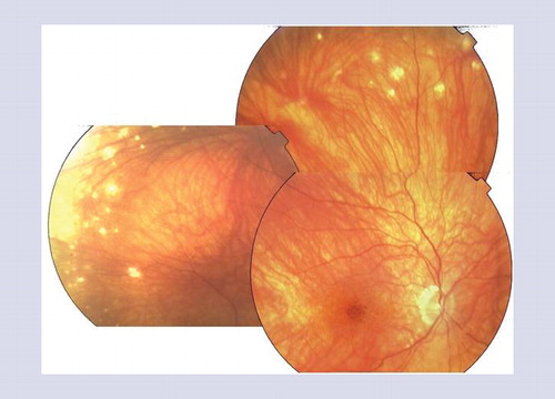 Figure 4. Fundus photograph of the right eye of a patient with chronic convalescent Vogt–Koyanagi–Harada disease shows depigmentation of the choroid with typical orange-red ‘sunset glow’ appearance of the fundus.Note the presence of nummular, round, well-limited chorioretinal depigmented scars located in the midperiphery and focal hyperpigmentation in the foveal area.
