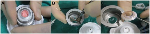 Figure 6 Disassembly of the anterior chamber begins by removing the guide ring, and blue and white locking rings and opening the balance salt solution stopcock. The metal cover is then rocked gently until balance salt solution is seen flowing (A). The entire apparatus is then inverted and the cover removed. Forceps are used to release any conjunctival adhesions (B) prior to removing the cornea scleral rim from the underside of the metal cover (C).