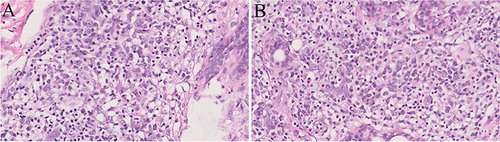 Figure 2 Histological findings of plaque on the head. (A and B) Prominent plasma cell infiltration of the dermis (HE, ×400).
