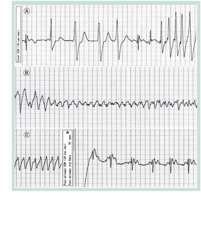 Figure 2. Appropriate shock in a 27 year-old woman with tetralogy of Fallot and a prophylactic implantable cardioverter-defibrillator.A stored ventricular electrogram is depicted with a continuous recording at 25 mm per second. (A) Premature ventricular beats are seen, followed by onset of a rapid ventricular tachyarrhythmia. (B) The ventricular tachycardia degenerated into a polymorphic form. (C) An appropriate implantable cardioverter-defibrillator discharge, marked by the asterisk, restored normal sinus rhythm at 78 bpm.