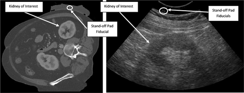 Figure 16. Sample CT (left) and ultrasound (right) images of patient's kidney with stand-off pad attached. Ultrasound acquisition settings were as follows: frequency 5 MHz; focal depth 7.6 cm; gain 42%; depth 13 cm.