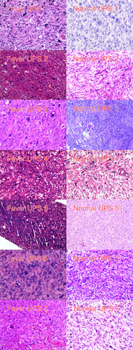 Figure 1 Pathological characteristics in all seven patients with UPS with fever (Fever UPS) and seven randomly selected patients with UPS without neoplastic fever (Normal UPS). Pathological manifestations were similar between the two groups. Histopathologically, all cases show high cellularity, myxoid area < 10%, and pleomorphic nuclear atypia.