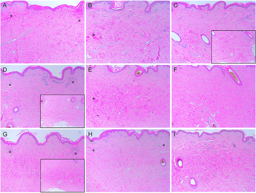 Figure 4 Immediate tissue reactions in in vivo minipig skin after PCC-assisted RF treatment. The skin of minipig was treated with RF at the frequencies of (A-C) 0.5 MHz, (D-F) 1 MHz, and (G-I) 2 MHz and the total treatment time and number of sub-pulse packs of (A, D and G) 500 ms and single pulse pack, (B, E and H) 1000 ms and six sub-pulse packs, and (C, F and I) 5000 ms and 10 sub-pulse packs. Inlet, histological photographs showing the mid and deep dermis. Asterisks, peri-electrode coagulative necrosis zones. Hematoxylin and eosin staining. Original magnification × 40.