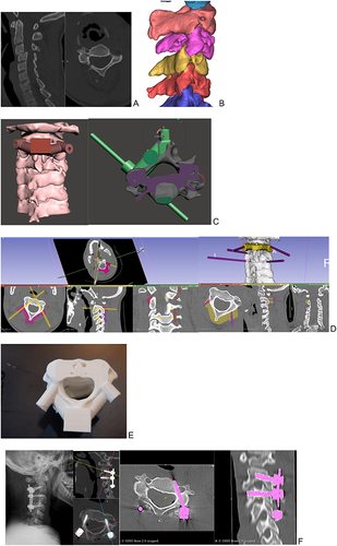 Figure 4 CT images showing C3 right pedicle fracture with a C3-C4 subluxation and a right-side locked facet (A); the 3D model created using Mimics® software to perform VSP (B); the VSP using Meshmixer® software and confirmation the pedicle screw trajectories using 3DSlicer® software (C and D); the personalized drill guide was used to fix pedicle screw (E); outcome of surgical treatment (F).