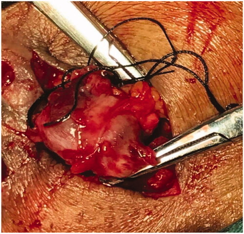 Figure 6. The mass removed by open surgery of case 3(a).