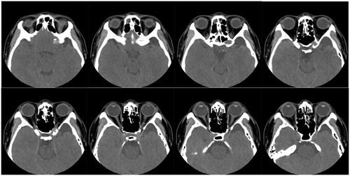 Figure 1. Initial axial CT scans without contrast of paranasal sinus. Although CT showed mild mucosal swelling or partial opacifications in bilateral sinuses, it was hard to identify the causative legion of optic neuropathy.
