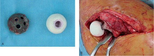 Figure 1. A. The cement spacer was molded in the shape of a hemiarthroplasty prosthesis over the sterilized head, according to the size of the retrieved acetabular cup. B. The molded cement spacer was attached to the retained femoral stem.