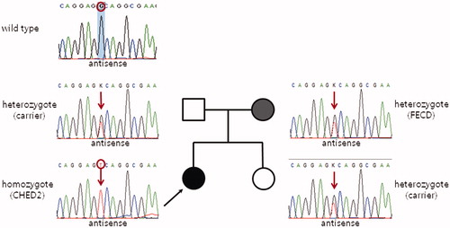 FIGURE 1. Partial sequences of the SLC4A11 gene show the mutation detected in this study. A novel nonsense mutation in exon 9 (c.1158C > A) leads to premature termination of the SLC4A11 protein instead of the 386th cysteine (p.C386*). The proband’s mother (Case 2), a heterozygous mutation carrier, showed late onset Fuchs endothelial corneal dystrophy phenotypes. Other family members with the mutation heterozygously had no corneal diseases clinically.