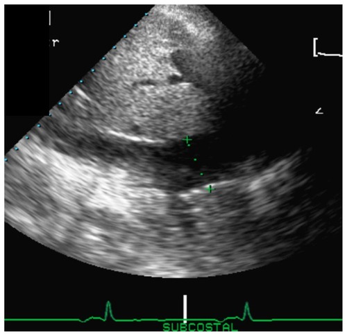 Figure 1 Examination of the inferior vena cava (IVC) in the subcostal long-axis view 1 cm from the right atria-inferior vena cava junction.