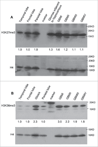 Figure 5. The abundance of H3K27me3 and H3K36me3 in MRI-classified GBM. (A) Western blot detected slightly elevated levels of H3K27me3 in MRI-classified SVZ-associated group I and group II GBM compared with control regions. (B) The level of H3K36me3 is increased in histone fractions of GBM patients. The unmodified H4 was used for loading control. The comparison was performed using normal brain specimens obtained from temporal, frontal, and parietal lobes. Quantification of enrichment ratio was done by ImageJ software. Enrichment ratio reflects intensity of tumor relative to mean of temporal, frontal, and parietal lobes after normalization to H4 loading control. The MRI-classified group I GBM is associated with both SVZ and cortex (SVZ+ cortex+), group II GBM (SVZ+ cortex−), group III GBM (SVZ− cortex+), group IV GBM (SVZ− cortex−). The gliosis associated with temporal region and gliomas associated with hippocampus were analyzed in parallel.