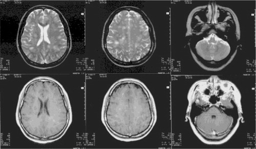 Fig. 1 A brain MRI on the 10th day after disease onset: various sized patches of slightly long T1 and slightly long T2 signal intensities scattered across the bilateral parietal gray–white matter junction zones, the subcortical white matter, and the semi-oval center and left cerebellum. Some of these lesions had clear boundaries, and others indicated brain swelling; most of the lesions exhibited small patchy enhancements following the intravenous injection of Gd-DPTA.