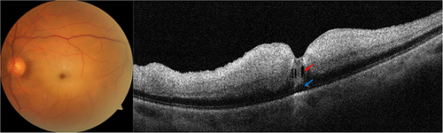 Figure 1 Representative case of acute central retinal artery occlusion with intraretinal and subretinal fluid. A 60-year-old hypertensive male patient presented with sudden drop of vision in the left eye down to hand motion. Fundus examination and photography of the left eye (left panel) showed whitening of the macular area and a cherry red spot appearance of the fovea. Optical coherence tomography (right panel) showed increased reflectivity, thickening and loss of the pattern of the inner retinal layers (from the outer plexiform layer to the internal limiting membrane). Small cysts of intraretinal fluid (red arrow) and a small subretinal fluid pocket (blue arrow) were noted in the foveal area.