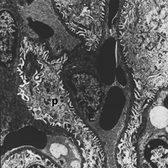 Figure 4 Podocytes (p) and endothelial cells (E) are seen in the electron microscopic photography of the kidney in Group 3. X 8837.