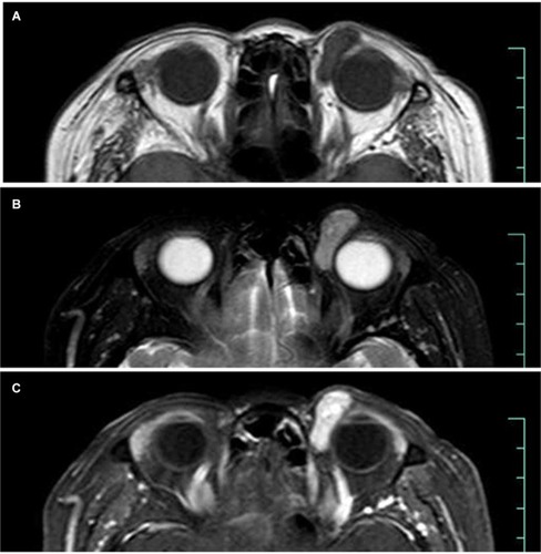 Figure 3 MR scan of Case 3 shows a well-circumscribed subcutaneous mass in the superomedial side of her left orbit with homogeneous isointense signal on T1 images and hypointense signal on T2 images.Notes: (A) T1 image, (B) T2 image, and (C) post-contrast T1 image.