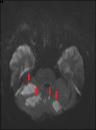 Figure 5 An axial view of a follow-up magnetic resonance imaging scan showing multiple areas of acute and subacute ischemic strokes in different cerebellar territories, with no additional cerebrovascular insults to the initial non-contrast computed tomography scan.