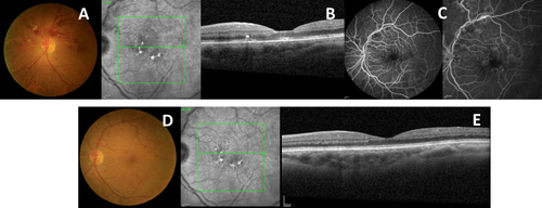 Figure 5 Case Report 5: At presentation: (A) Superior hemiretinal hemorrhage on Retinography; (B) Macular SD-OCT with patterned dystrophy of the retinal pigment epithelium but without macular edema; (C) AF with some ischemic areas in the upper retina with some contrast diffusion. At 6th month of symptoms: (D) Rare hemorrhage on Retinography; (E) Macular SD-OCT with patterned dystrophy of the retinal pigment epithelium but without macular edema.