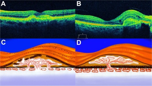 Figure 13 (A–D) The histopathologic (artist representation) and clinical correlation of occult and classic choroidal neovascularization to the Gass classification of type I (A and B) and type II membranes (C and D).