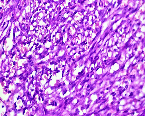 Figure 7 Under 100X magnifications, shows hyperchromatic spindle cells forming vascular slits and sieve-like blood-filled spaces. Accompanying mononuclear inflammatory infiltrates.