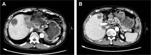 Figure 6 Stable disease after second round of apatinib use (A and B, May 11, 2017).