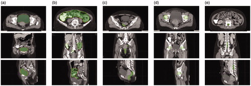 Figure 4. The automatic segmentation result of CT images. (a) Bladder, (b) intestine, (c) rectum, (d) femur, (e) cord.