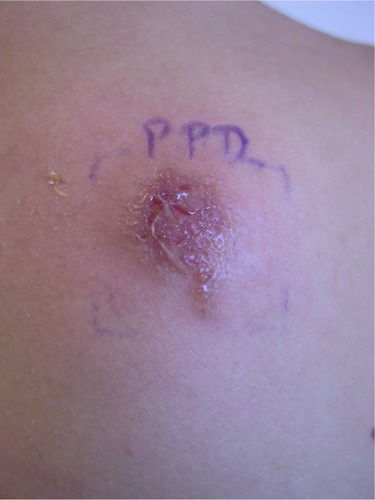 Figure 3 Blistered positive patch test reaction on day 4 to 1% PPD.