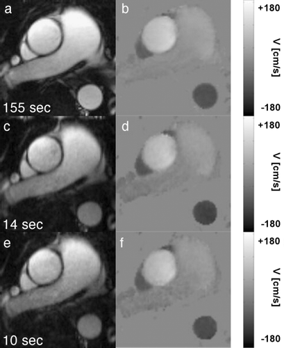 Figure 2. Anatomical images and velocity maps acquired during peak systole using PC‐SSFP ((a,b) reference scan, (c,d) 5 × k‐t BLAST and (e,f) 8 × k‐t BLAST). The numbers indicate the actual scan time.