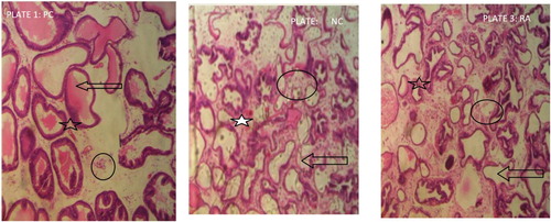 Plate 1-3. (HE-200X): photomicrographs obtained from histopathological examination of prostate tissue sections from experimental groups PC, NC and RA. Group PC (positive control): Distilled water + Food only.NC: (negative control): ARG+ MSG 90:22.5 mg kg−1 b.wt. RA: ARG+ MSG+ extract: 90:22.5:100 mg kg−1 b.wt.. Key: [ð] indicate lumen, [★] shows the gland unit while [○] shows the stroma and epithelial nuclei.