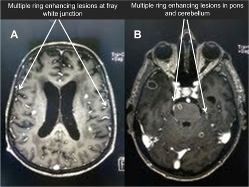 Figure 2 Brain MRI.
