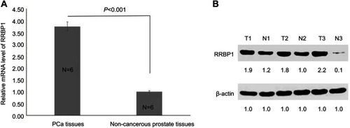 Figure 1 RRBP1 was highly expressed in PCa. (A) Relative mRNA level of RRBP1 was detected in PCa and non-cancerous prostate tissues by RT-qPCR, and mean ± SD represented three independent experiments. (B) RRBP1 protein expression level was detected in PCa and non-cancerous prostate tissues by Western blot, and the gray density of each protein brand was recorded.Abbreviations: T, tumor; N, non-cancerous prostate tissues; RRBP1, ribosome binding protein 1; PCa, prostate cancer; RT-qPCR, reverse transcription-quantitative PCR.