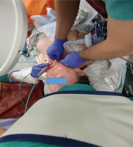 Figure 4 First DLET in the FS, a second DLET is used for distal ventilation.